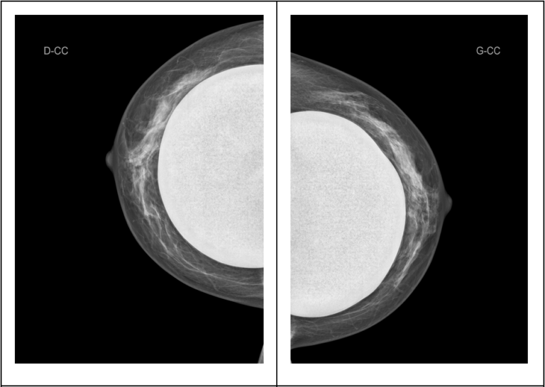 Mammographie avec prothèse