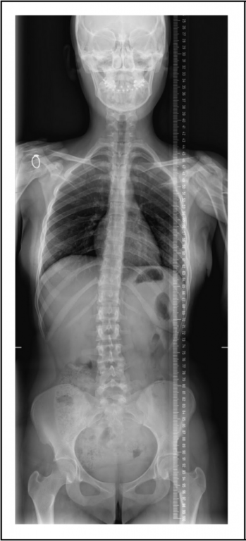 Radiographie colonne vertébrale