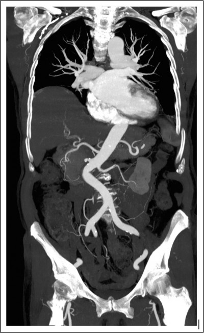 Scanner aorte abdominale