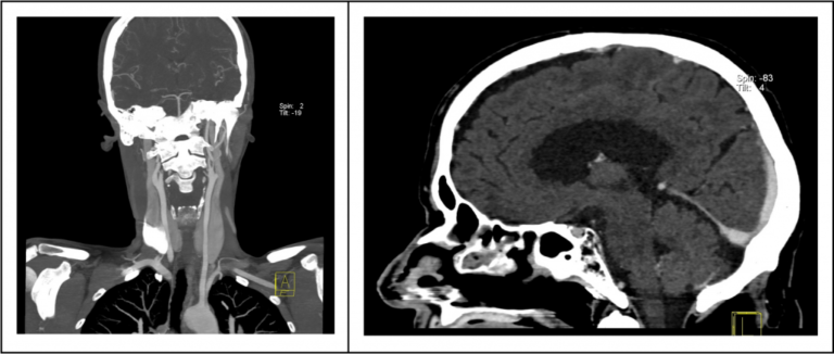 Scanner examen neurologique