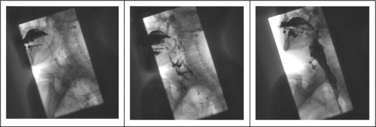 Transit oeso-gastro-duodenal (TOGD)